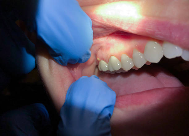 Best Emergency Wisdom Tooth Extraction in Compo, CT